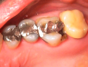 Vergleich_Füllungen